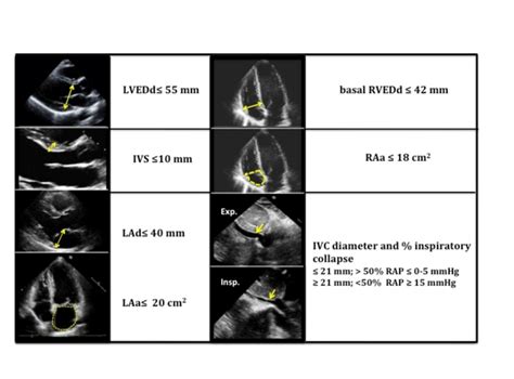 lv dilation echo|normal lv end diastolic diameter.